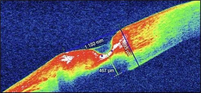 (Following systemic immunosuppression): AS-OCT shows a reduction in ulcer depth to 338 µm and a narrower ulcer width of 1180 µm, suggesting minimal therapeutic response. The ulcer bed remains irregular with persistent stromal hyperreflectivity, likely due to ongoing inflammation. The overhanging edge is less prominent, and partial re-epithelialization is observed.
