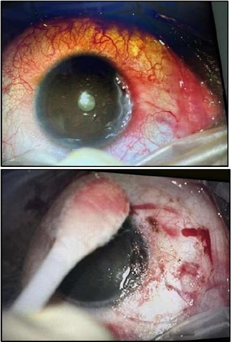 OS, Intraoperative photo showing excision of a 4 mm-wide strip of perilimbal conjunctiva between 7 and 10 o’clock, adjacent to the area of stromal ulceration.